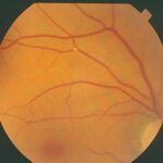 What is Visual Impairment? - Living well while visually or sight impaired