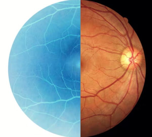 Retina Clinical Trials